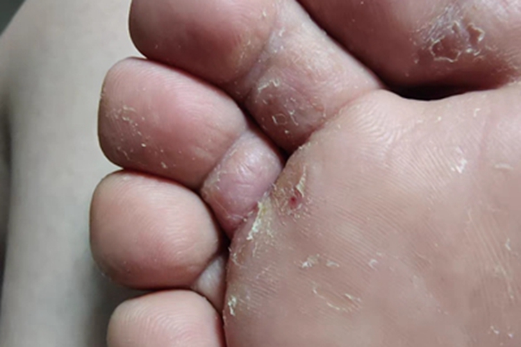 鳞屑角化型足癣脚趾糜烂图