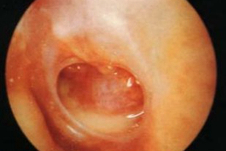 急性化脓性中耳炎外耳道渗液图 急性化脓性中耳炎外耳道渗液图