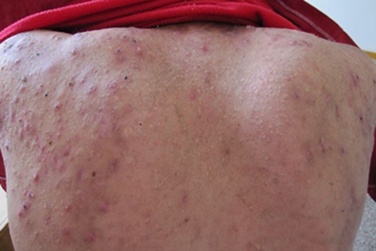 聚合性痤疮背部大红疙瘩图