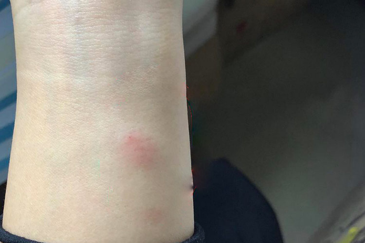 青霉素皮试阳性皮丘隆起图