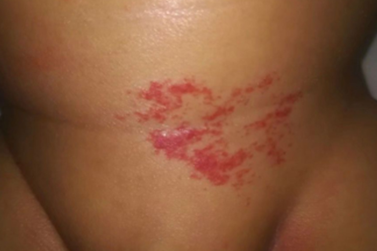 血管瘤颜色消退图