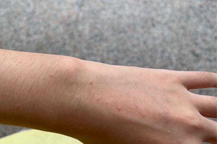 痒疹手背红点图