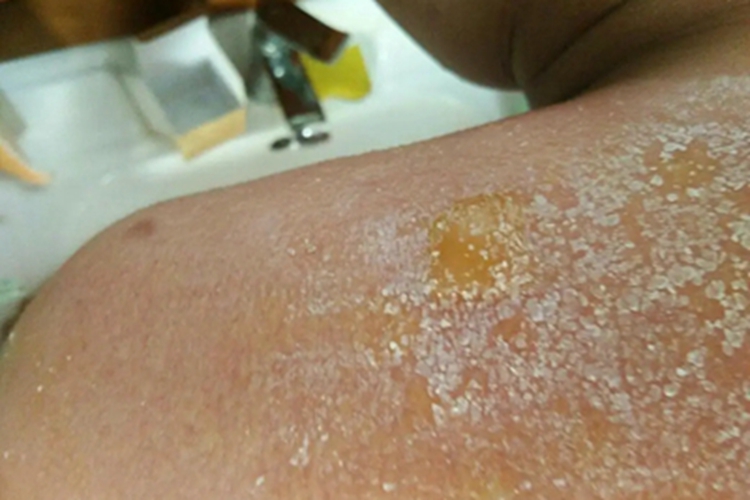 日照性皮炎肩部脱屑图
