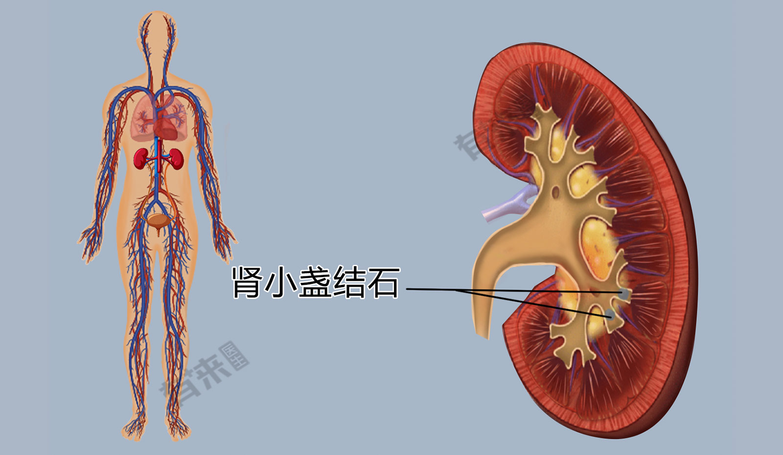 肾小盏图片