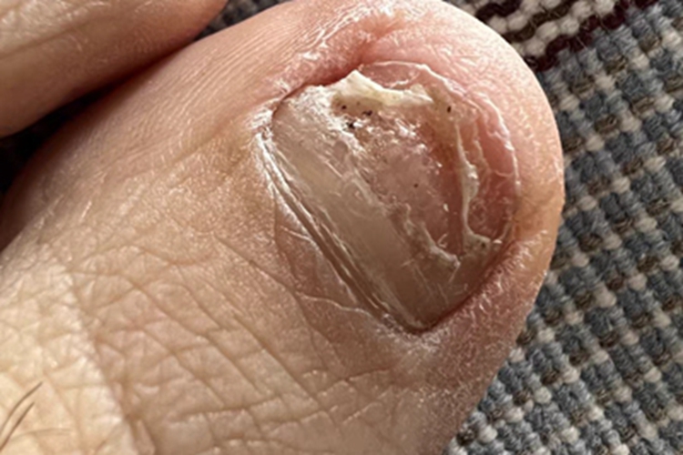 全甲损毁型甲真菌病脚趾甲图 全甲损毁型甲真菌病脚趾甲图