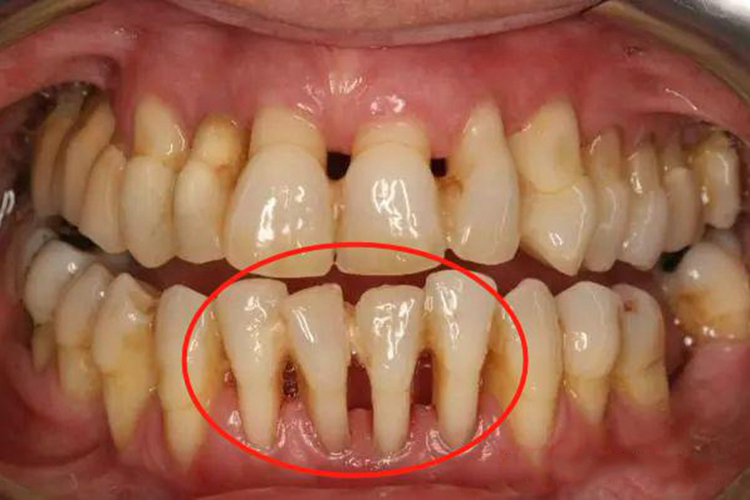 重度牙龈萎缩图