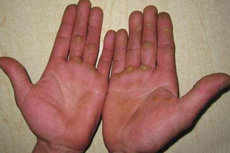 进行性掌跖角化病症状图 进行性掌跖角化病症状图