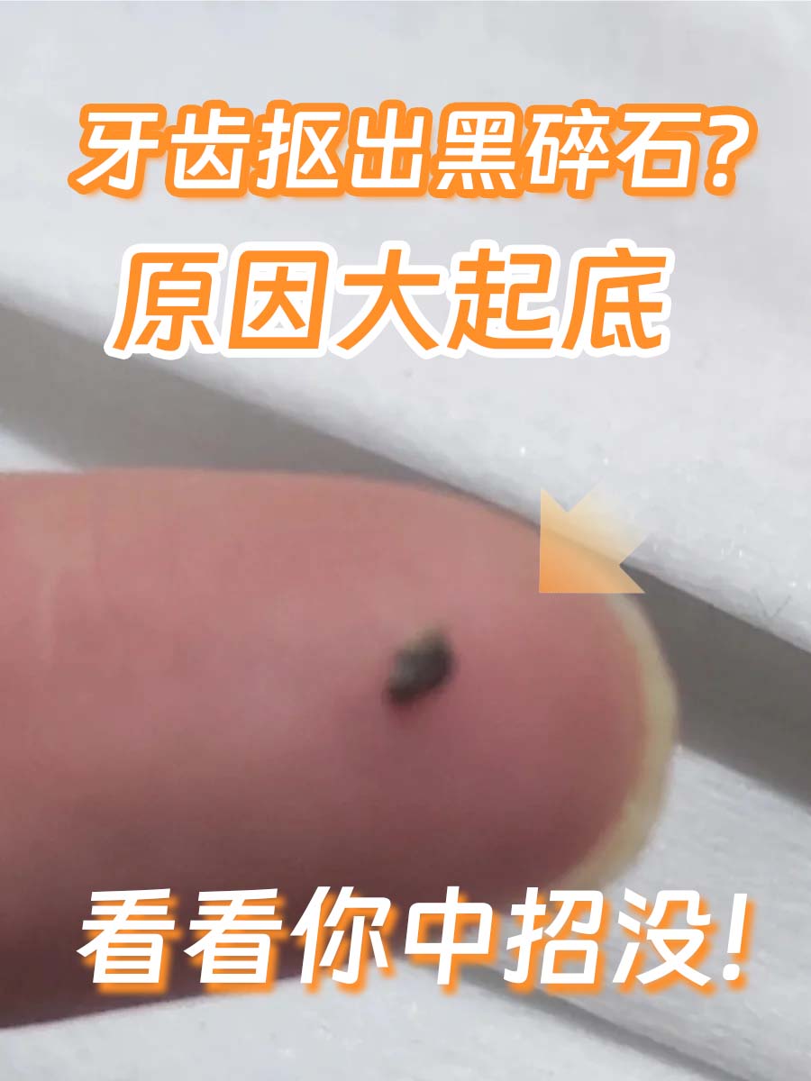 牙齿抠出黑碎石？原因大起底，看看你中招没！