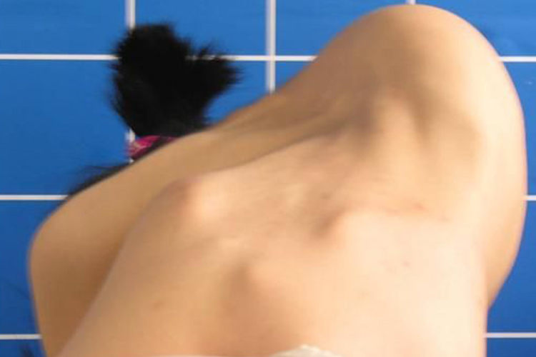 儿童脊柱侧弯剃刀背图