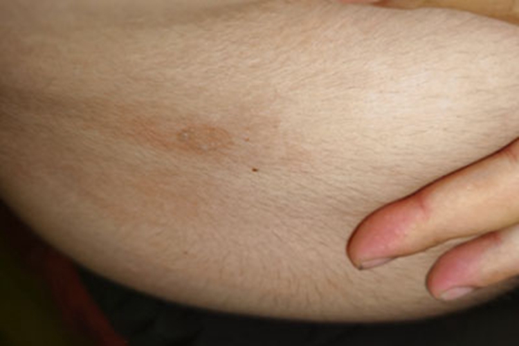 体癣腹部斑块脱屑图