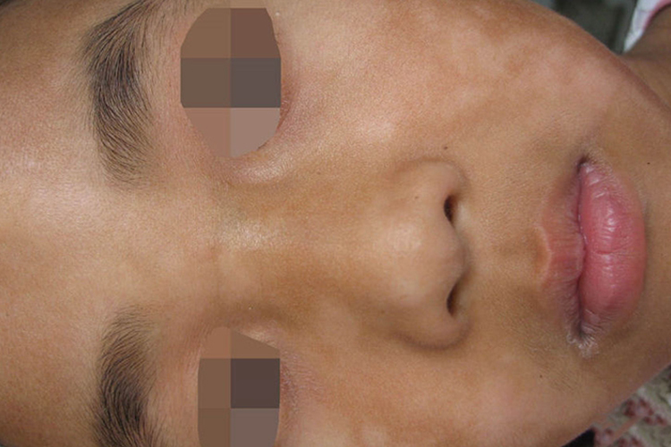 孩子脸上有虫斑图 孩子脸上有虫斑图