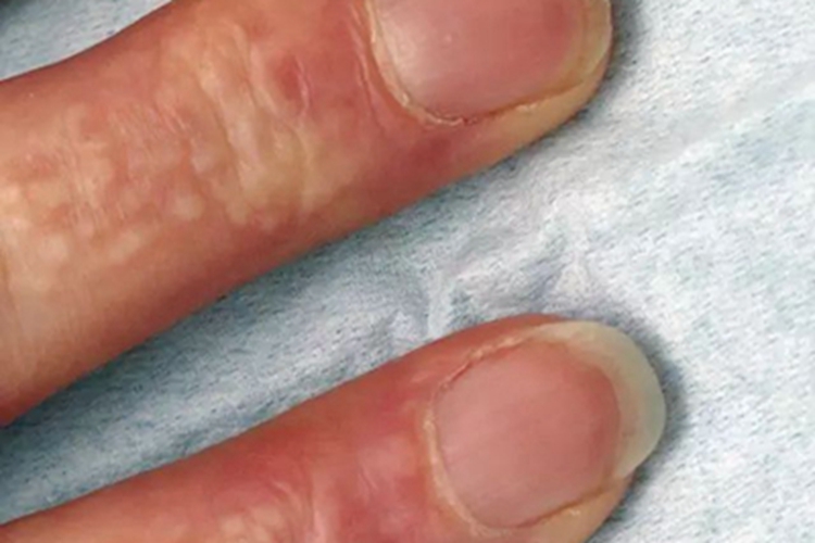 局限性黏液水肿性苔藓手指症状图
