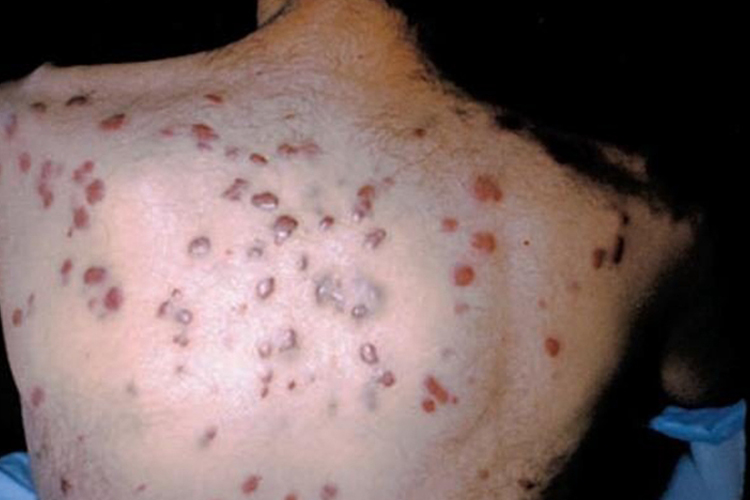 后背卡波西肉瘤图