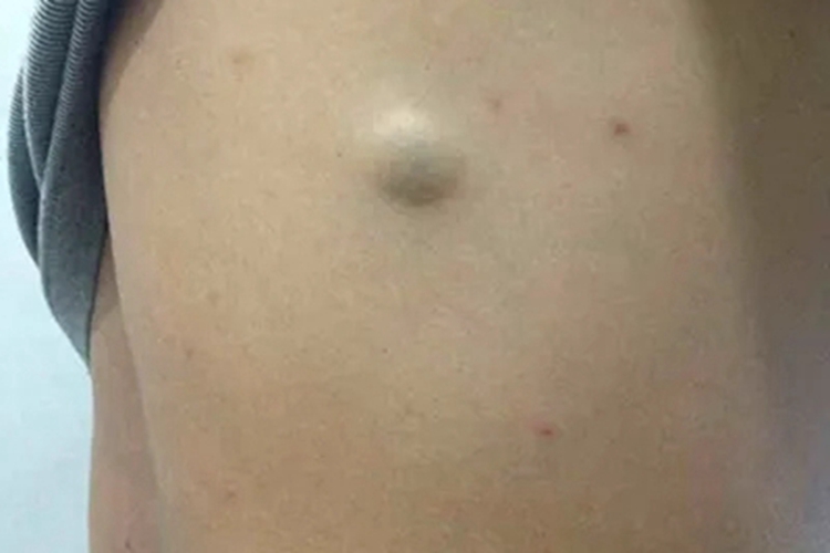 毛母质瘤背部肿块图 毛母质瘤背部肿块图