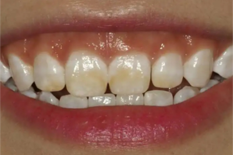 氟骨症牙齿长淡黄斑图