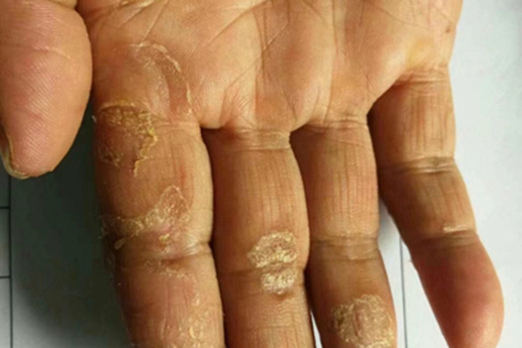 手部湿疹皮肤增厚图