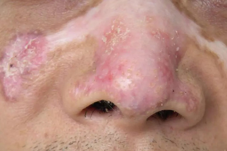 早期的红斑型红斑狼疮图