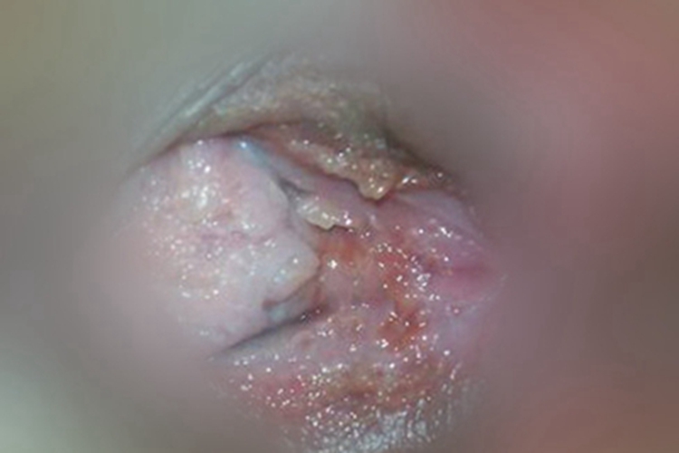 女性生殖器疱疹小水疱图 女性生殖器疱疹小水疱图