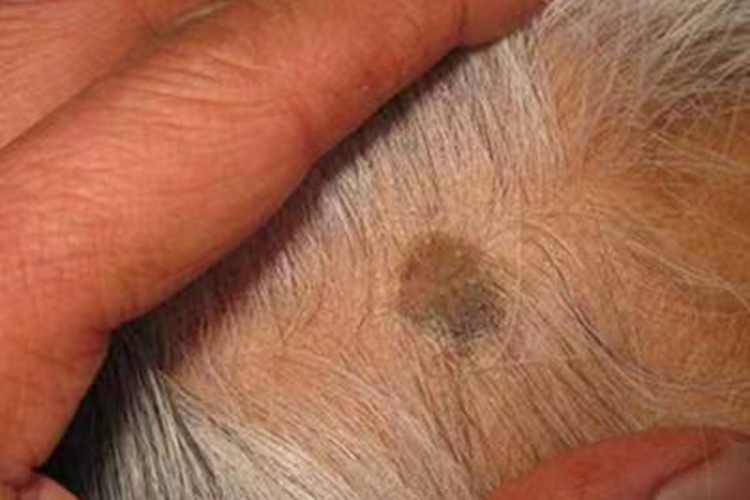 头皮脂溢性角化病黑斑图