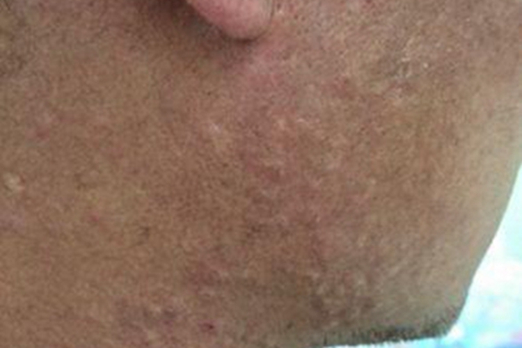 全身性瘙痒症面部丘疹图