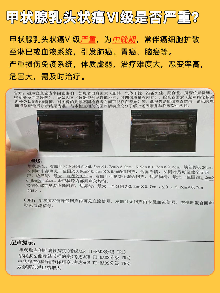 快速了解：甲状腺乳头状癌Ⅵ级严重吗？