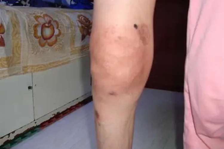 类风湿性关节炎膝关节肿胀图