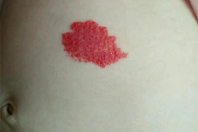 蔓状血管瘤腹部红斑图