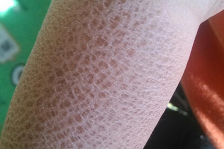 毛囊性鱼鳞病斑图 毛囊性鱼鳞病斑图