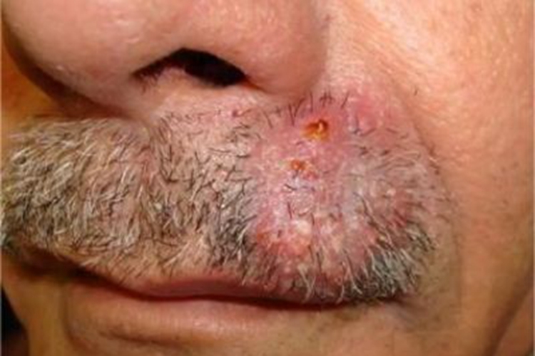 深在型须癣脓包图 深在型须癣脓包图