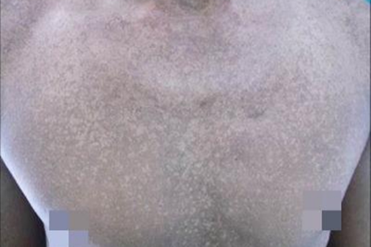 遗传性泛发性色素异常症白点图