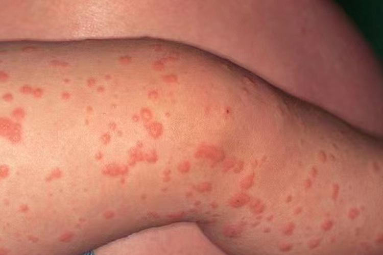 小儿丘疹性肢端皮炎扁平丘疹图