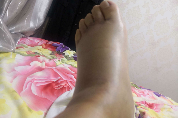 女性崴脚左脚肿胀图