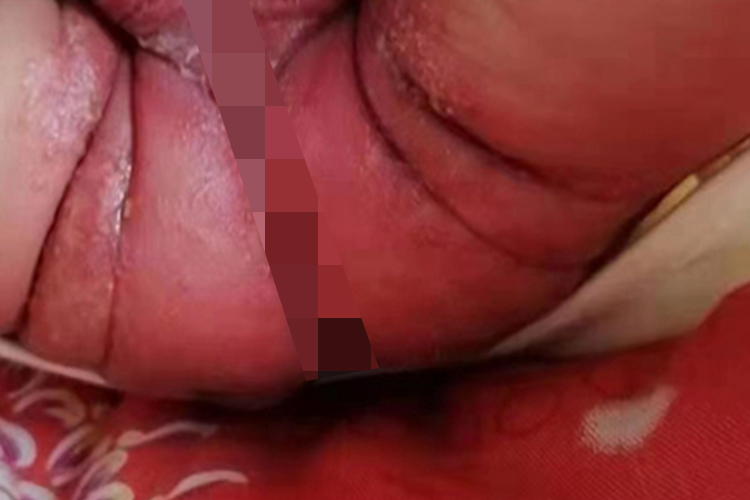尿布皮炎屁股红肿起皮图