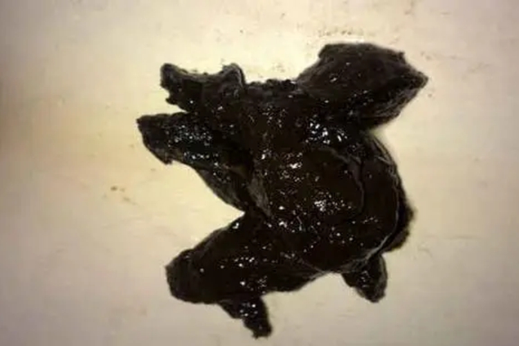 胃癌早期黑便图