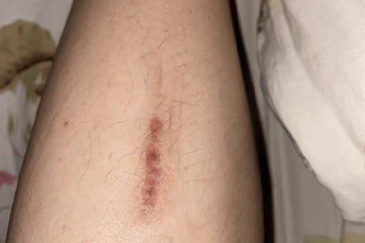 瘢痕疙瘩小腿有条状瘢痕图