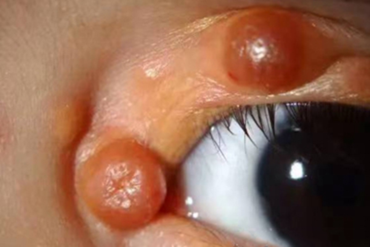 幼年黄色肉芽肿眼部丘疹图