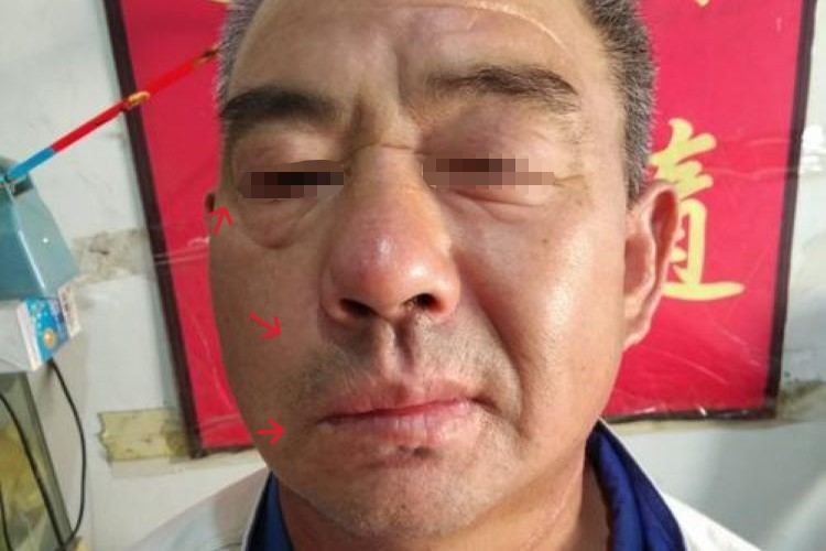 面瘫较轻图 面瘫较轻图