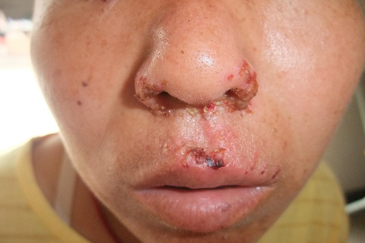 鼻孔带状疱疹图片
