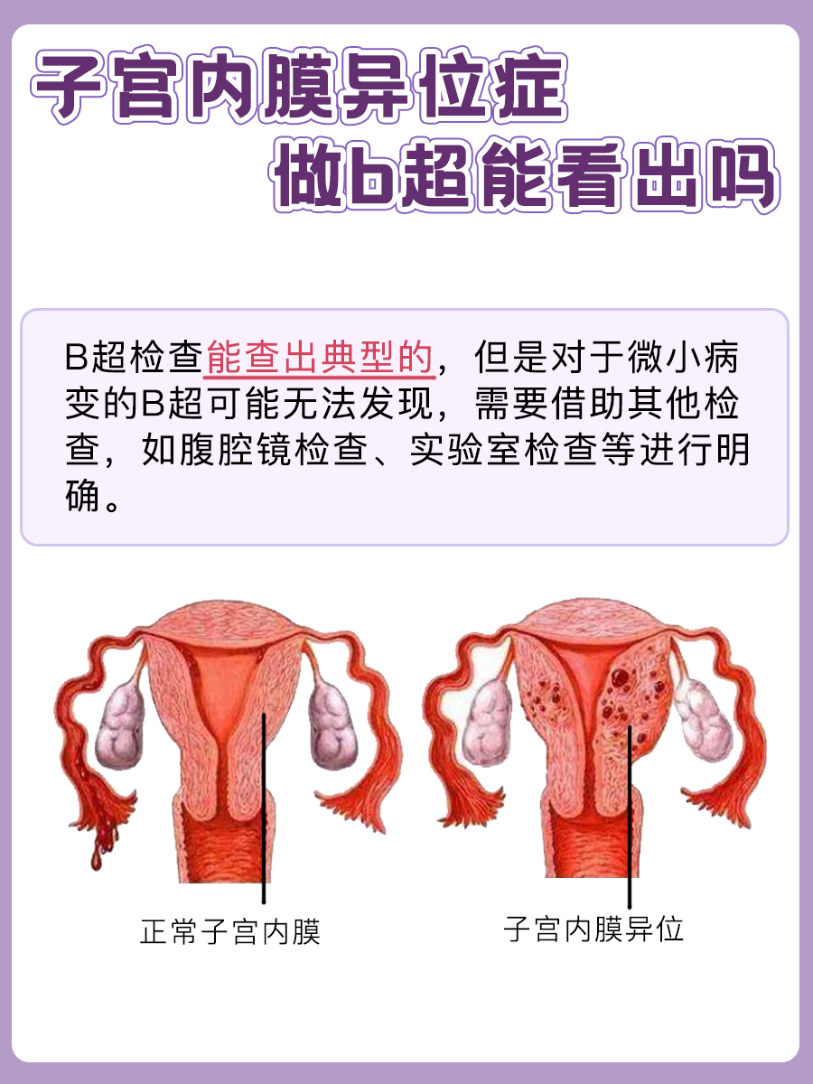 子宫内膜异位症做B超能看出吗？听医生怎么说