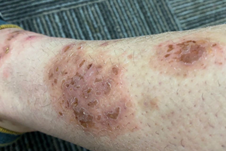 变应性皮肤血管炎小腿结痂图