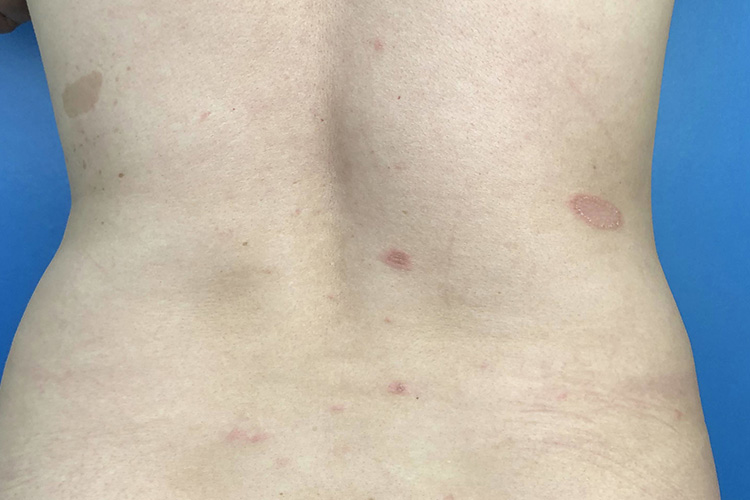 玫瑰糠疹背上长圆圈癣图