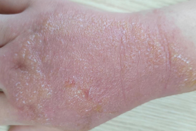 急性接触性皮炎手背红斑图 急性接触性皮炎手背红斑图