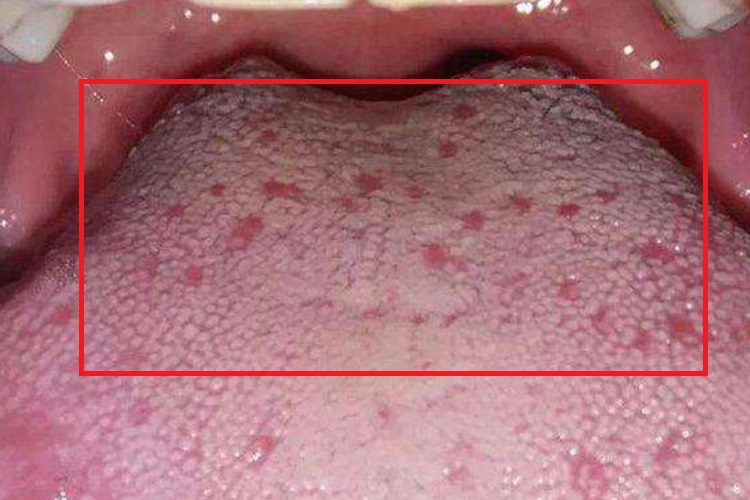 菌状乳头炎图 菌状乳头炎图