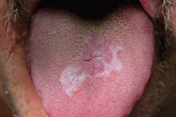 舌部扁平苔藓白色花纹图 舌部扁平苔藓白色花纹图