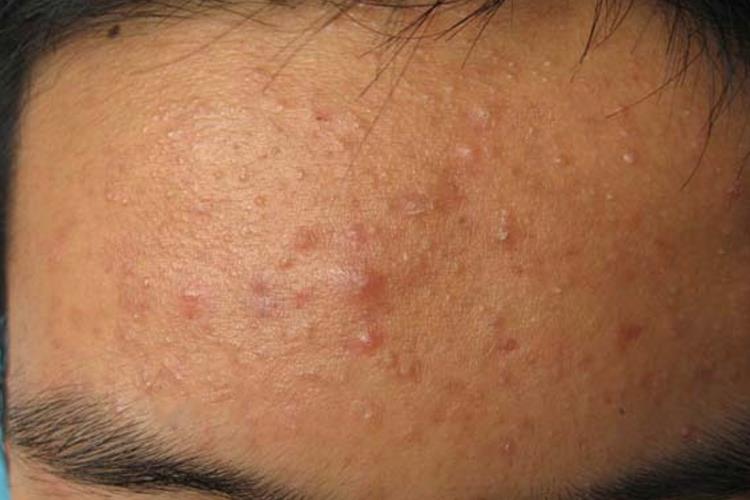 脸部毛囊炎初期丘疹图 脸部毛囊炎初期丘疹图