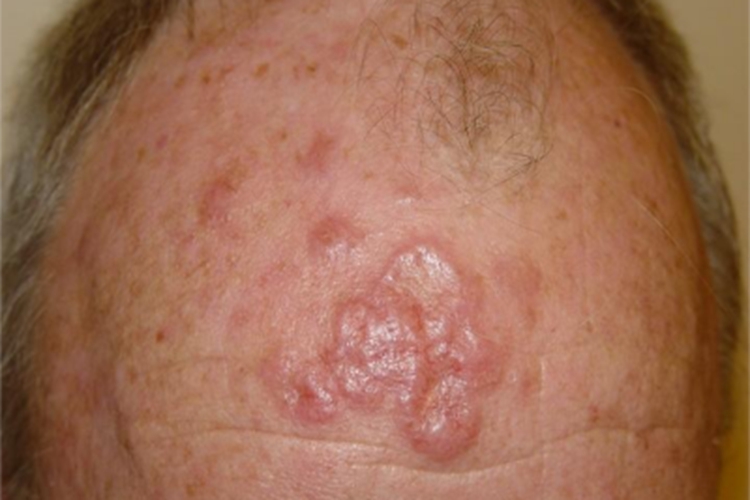 油性肉芽肿脑门有疙瘩图 油性肉芽肿脑门有疙瘩图