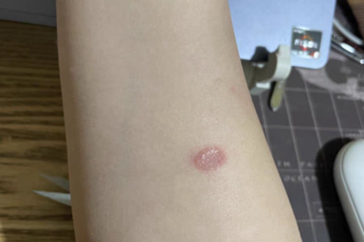 体癣胳膊上有椭圆形红斑图