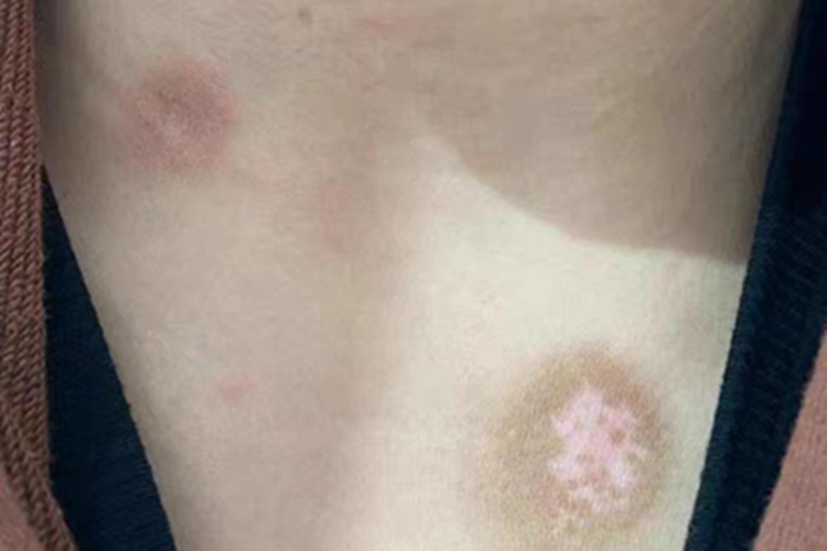 稳定期节段型白癜风胸部白斑图