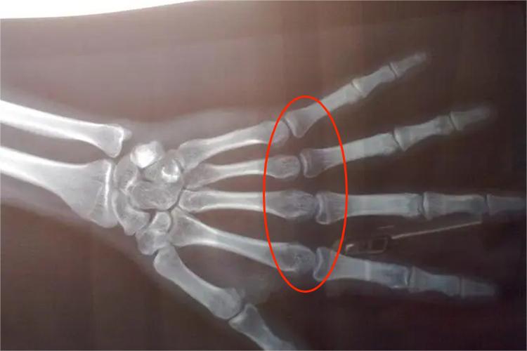 骨骺线闭合高清图