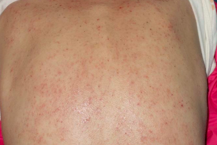 青年成年期后背特应性皮炎图